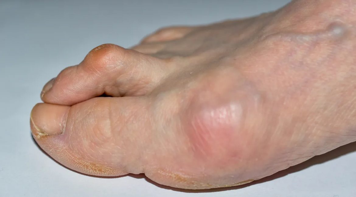 Σφυροδακτυλία (Hammer Toe)