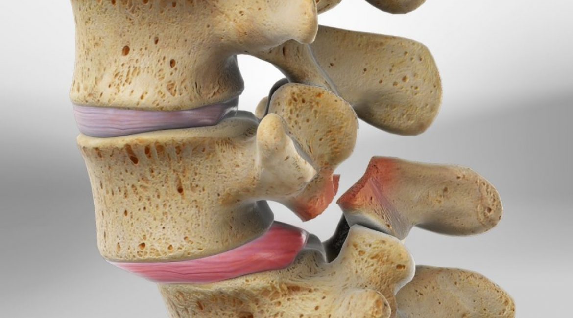 Σπονδυλολίσθηση ενηλίκων στη μέση