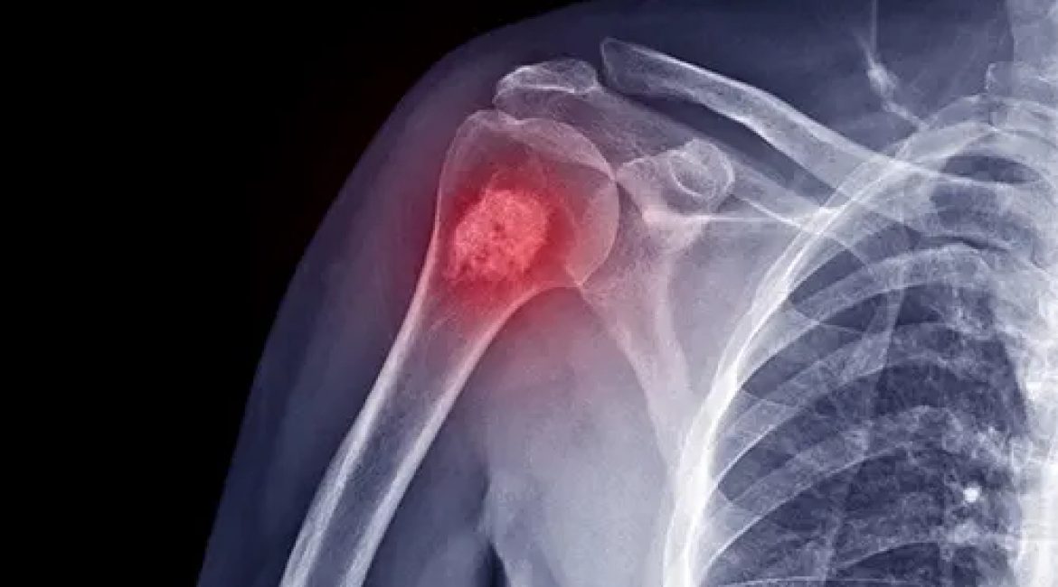 Ανευρυσματική κύστη οστών