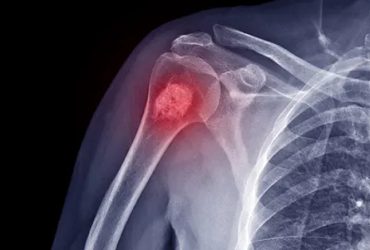 Ανευρυσματική κύστη οστών