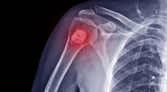 Ανευρυσματική κύστη οστών