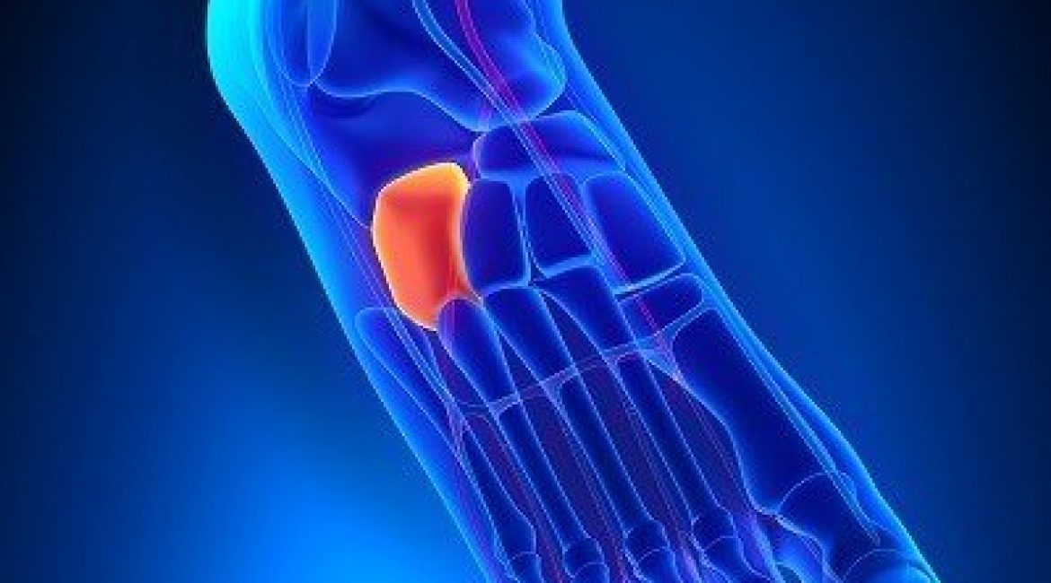 Σύνδρομο κυβοειδούς