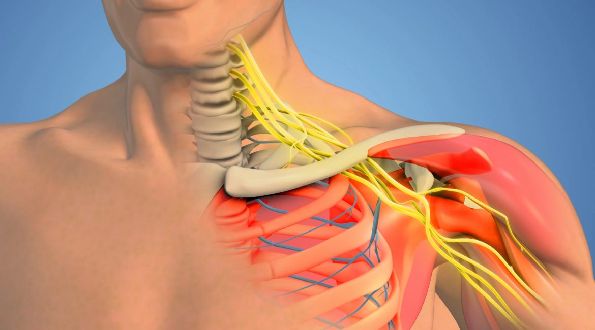 Σύνδρομο θωρακικής εξόδου