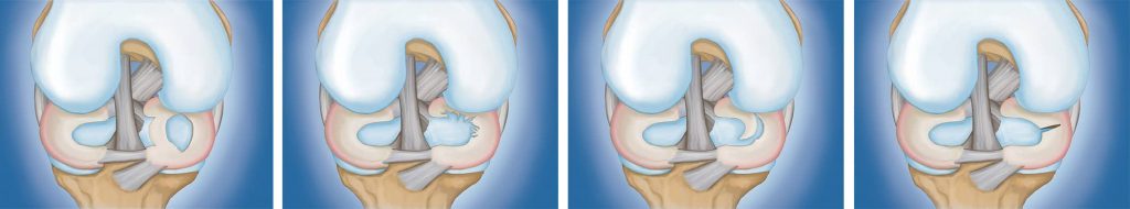 Τύποι ρήξεων μηνίσκου