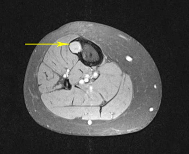 Αξονική τομογραφία όγκου των οστών