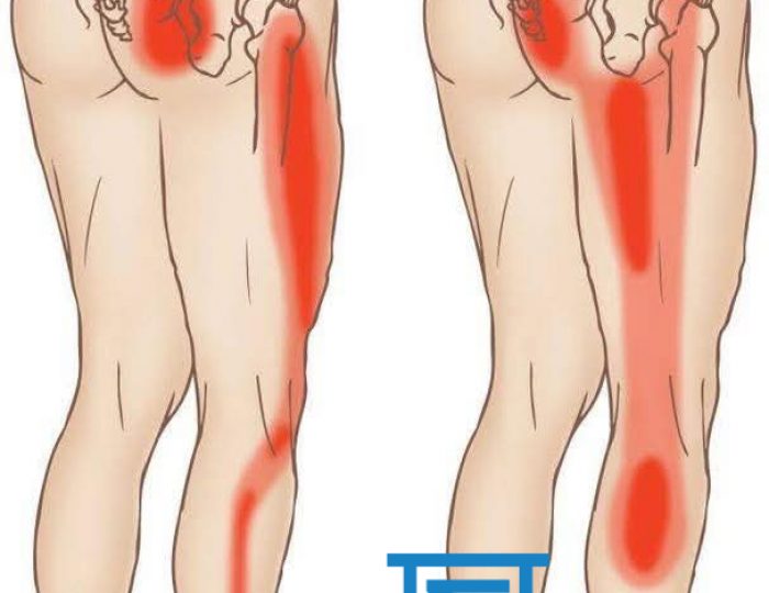 ΣΥΝΔΡΟΜΟ ΑΠΙΟΕΙΔΗ