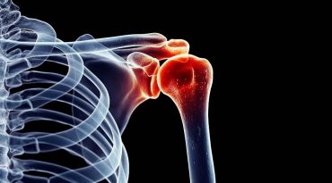 Ασβεστοποιός τενοντίτιδα του ώμου