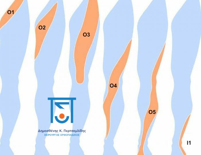 Δερμοτόμια κάτω άκρου