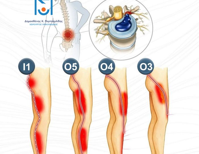 Δερμοτόμια ΟΜΣΣ