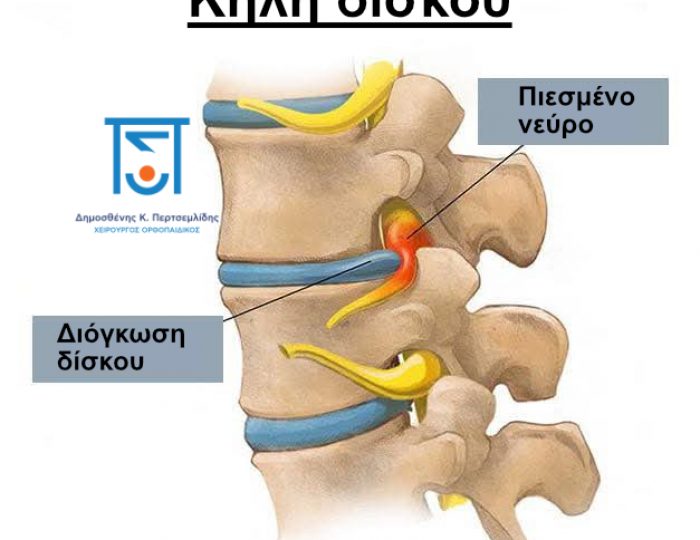 Κήλη δίσκου