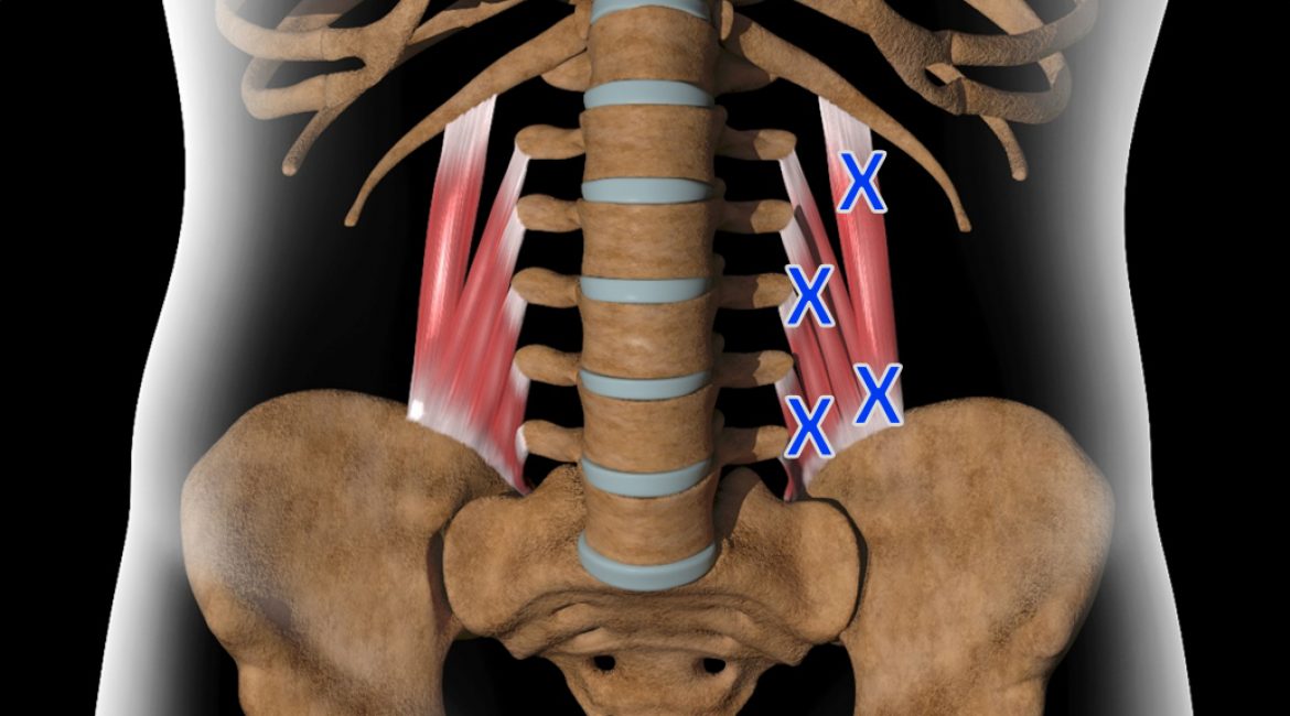 Τετράγωνος Οσφυϊκός – Οξεία Οσφυαλγία