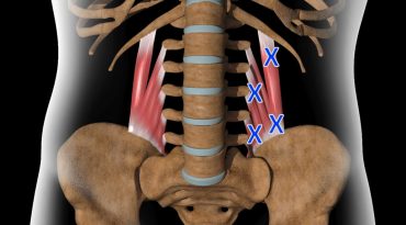 Τετράγωνος Οσφυϊκός – Οξεία Οσφυαλγία