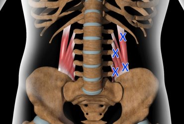 Τετράγωνος Οσφυϊκός – Οξεία Οσφυαλγία