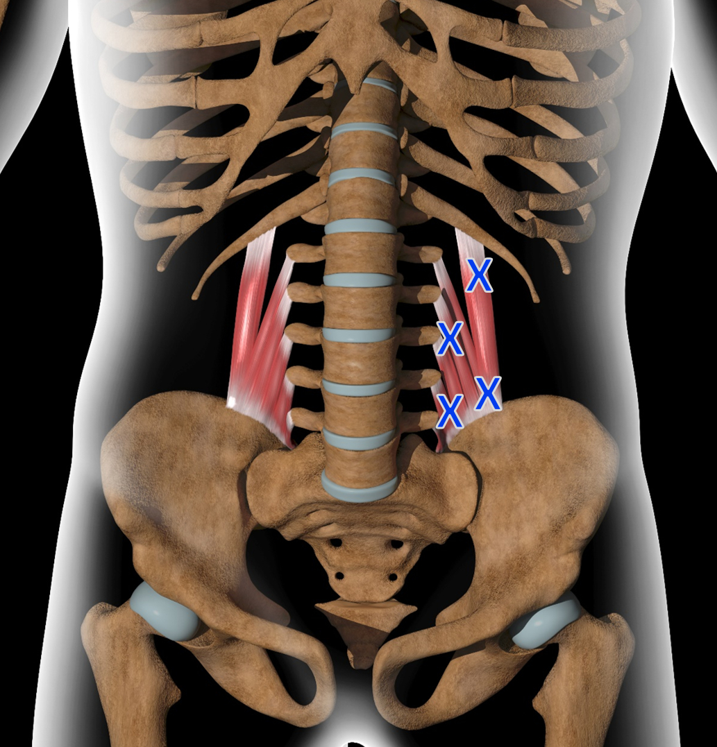 Τετράγωνος Οσφυϊκός – Οξεία Οσφυαλγία