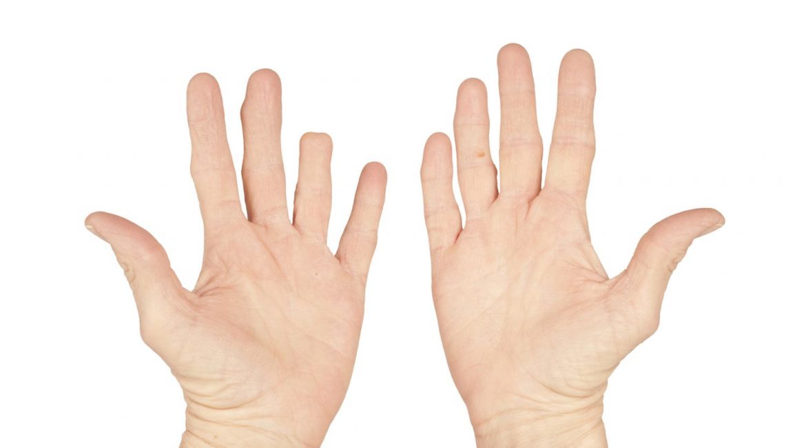 Τραυματισμοί και ακρωτηριασμοί στα δάχτυλα