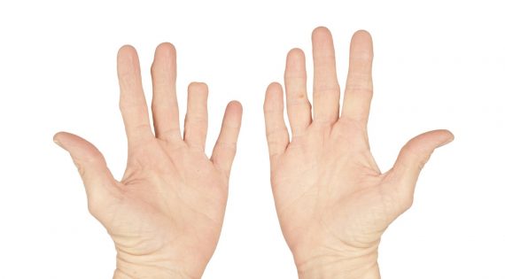 Τραυματισμοί και ακρωτηριασμοί στα δάχτυλα