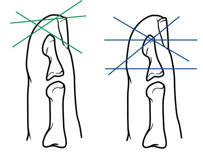 Γωνίες τραυμάτων στις άκρες των δακτύλων