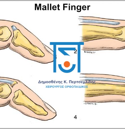 Mallet Finger