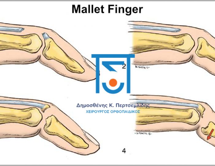 Mallet Finger