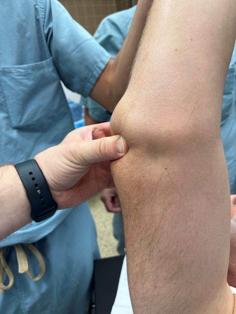Photo Showing Dent Created When the Triceps Tendon Pulls Up Away From The Elbow